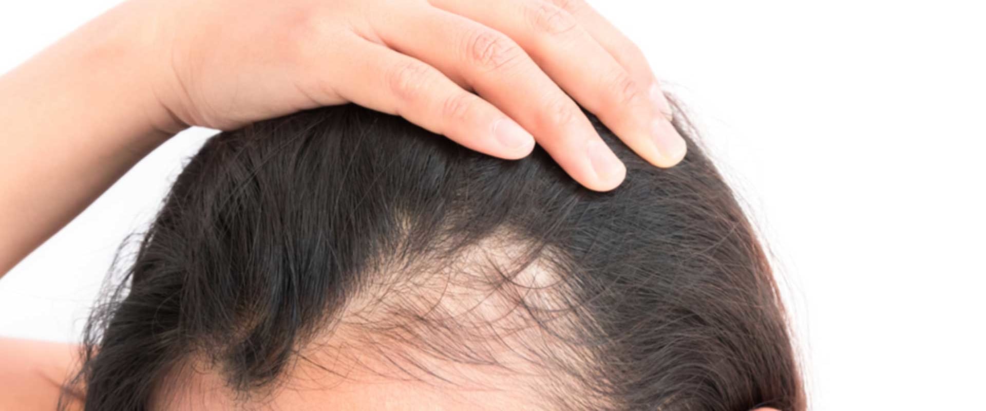 How long after the gastric sleeve does hair loss stop?