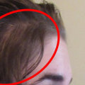 Why do gastric sleeve patients lose hair?