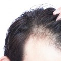 How do I know if hair loss is permanent?