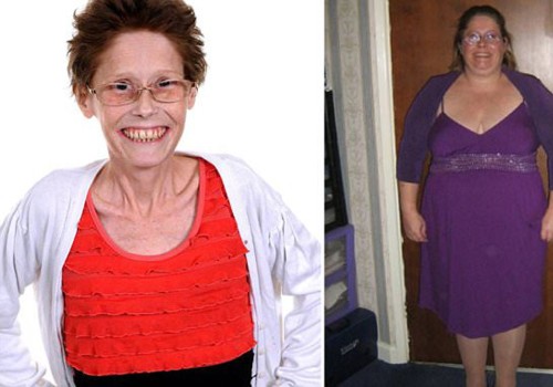 What are the signs of malnutrition after bariatric surgery?
